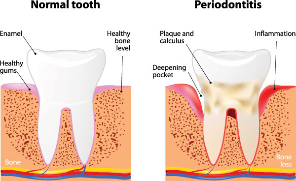 Periodontal Dental Treatment in Yonkers