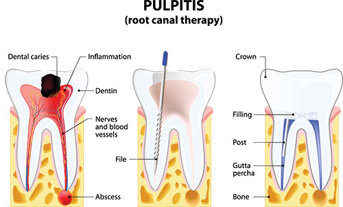 Root Canal Treatment in Yonkers