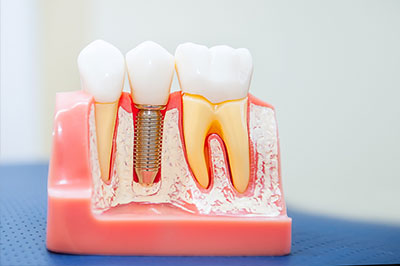 Dental Implants in Yonkers