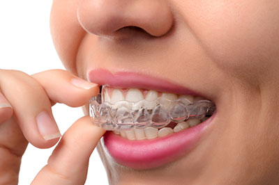 Invisalign 10701