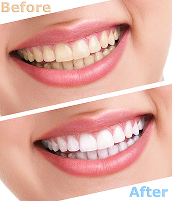 Yonkers Teeth Whitening