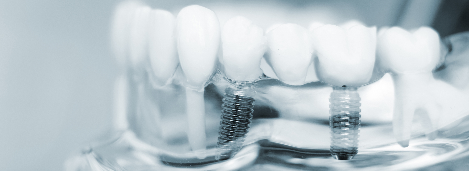 Dental Implants Yonkers